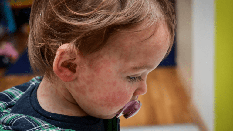 Measles outbreak